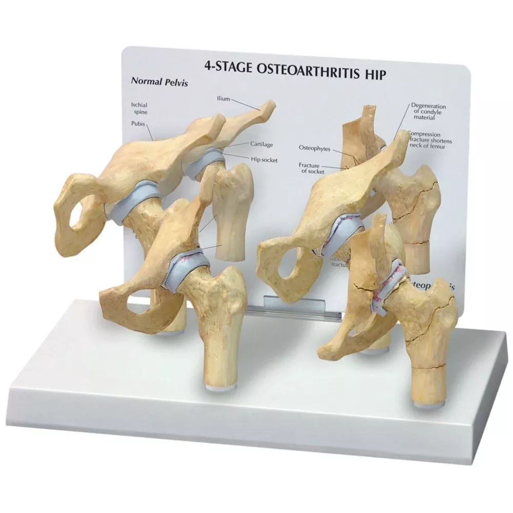 GPI Anatomicals 4-Stage Arthritic Hip Model 4-Stage Arthritic Hip Model - 711464