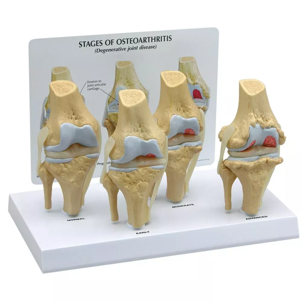 GPI Anatomicals 4 Stage Osteoarthritis Knee Model 4 Stage OA Knee Model - 70573