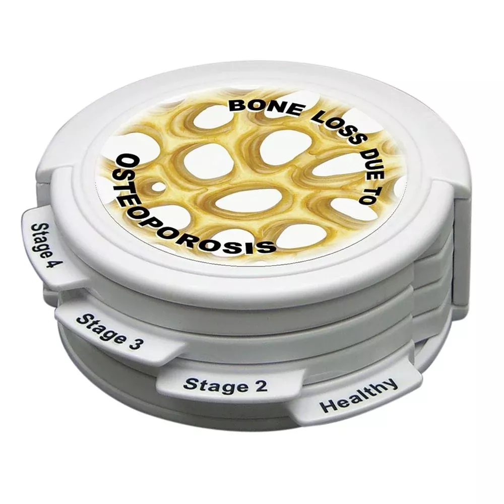 GPI Anatomicals 4 Stage Osteoporosis Model 4 Stage Osteoporosis Model - 52475