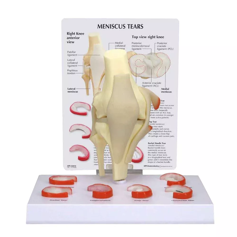 GPI Anatomicals Meniscus 6 Tears Model Meniscus 6 Tears Model - 713506