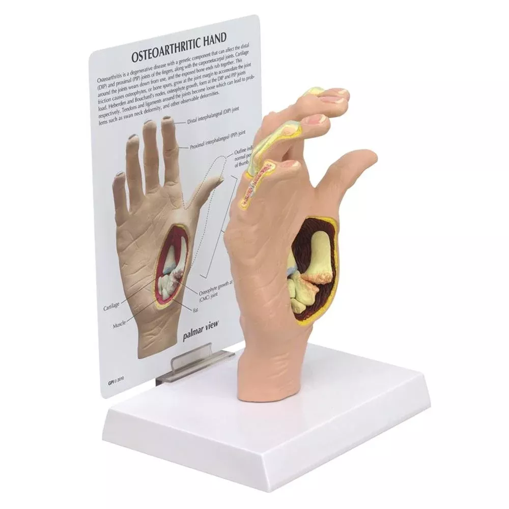 GPI Anatomicals Osteoarthritis (OA) Hand Model Osteoarthritis (OA) Hand Model - 712640