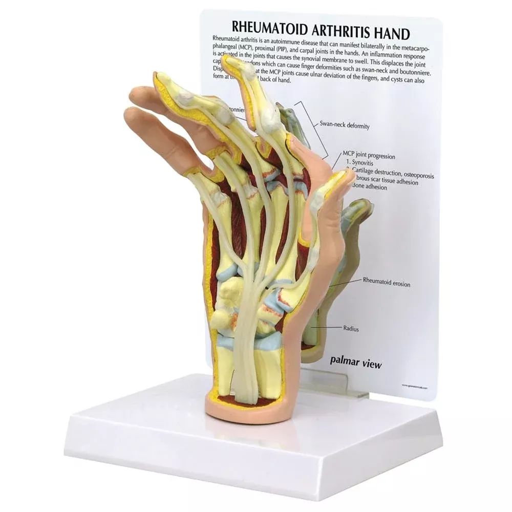 GPI Anatomicals Rheumatoid Arthritis (RA) Hand Model Rheumatoid Arthritis (RA) Hand Model - 712641