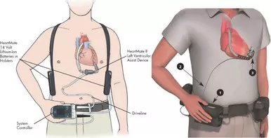 Medline DM330A - UOU LVAD Driveline Management, Complications