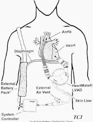 Medline DM585 - LVAD Management System, Chronic